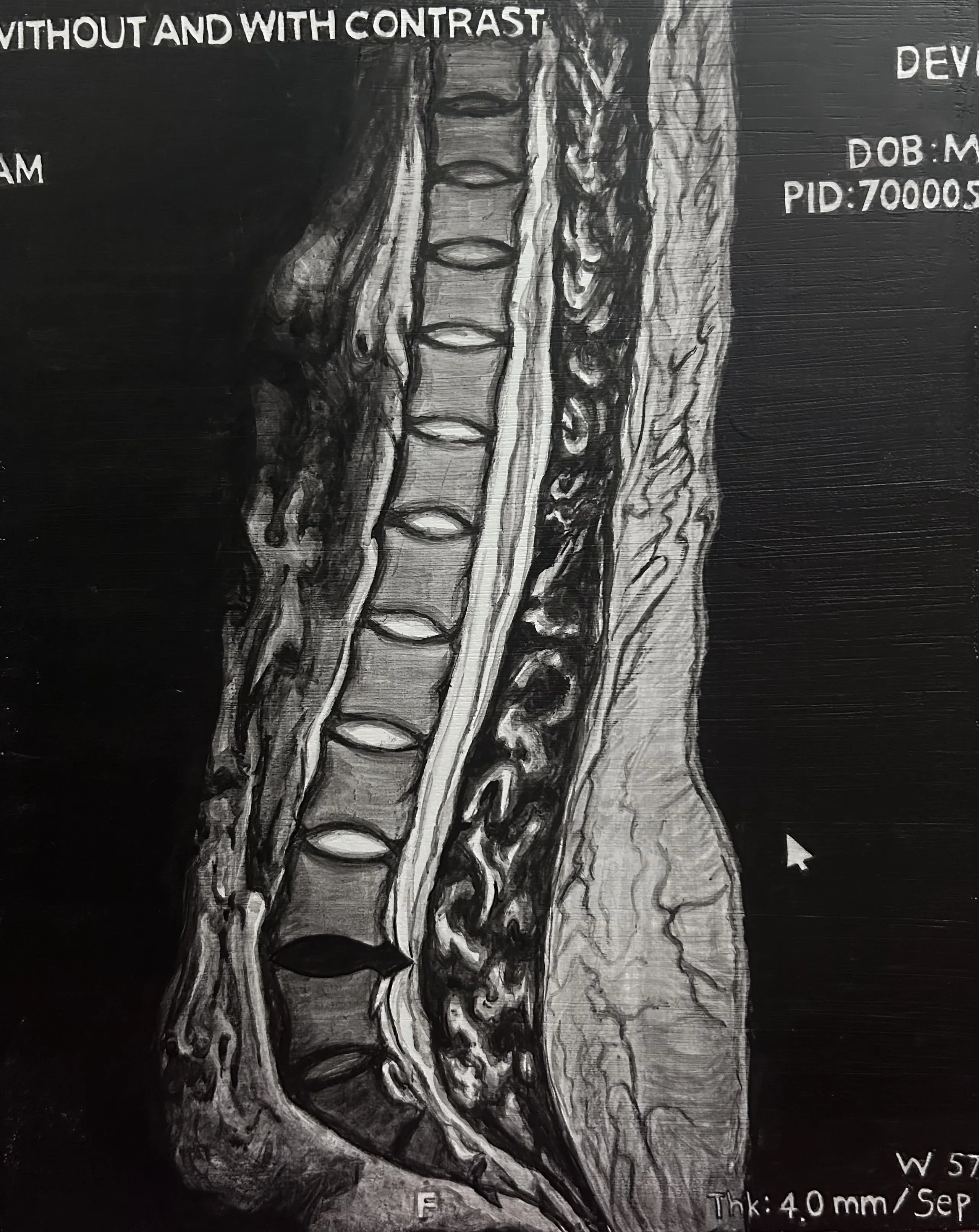 6 pre-op-2026-acrylic_